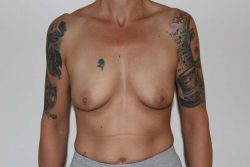 Before breast augmentation