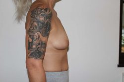 Before breast augmentation