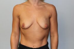 Before breast augmentation
