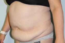 Before abdominoplasty