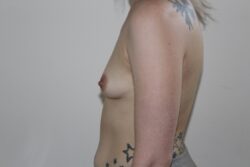 Before breast augmentation