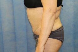 After abdominoplasty