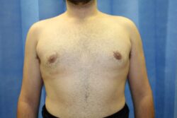 After male breast correction