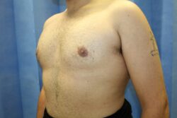 After male breast correction