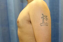 After male breast correction
